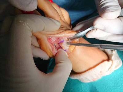 hallux_valgus_juanete_2